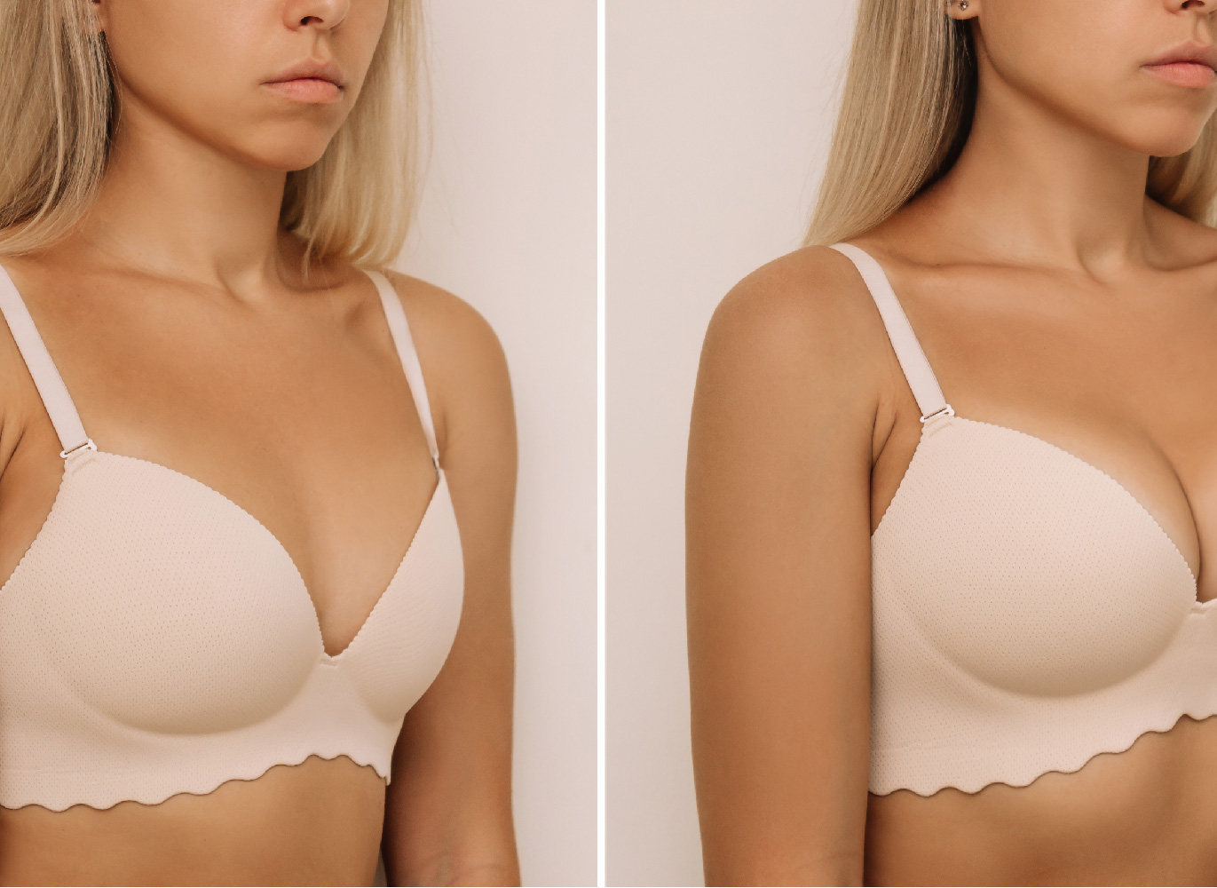 Breast Asymmetry Correction